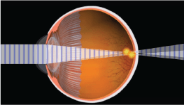 diagram of eye condition